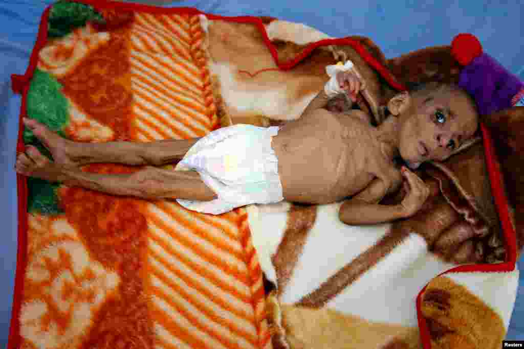 One-year-old Fatima Abdullah Hassan, who suffers from severe malnutrition, lies in bed at a malnutrition treatment center in the Red Sea port city of Hodeida, Yemen.